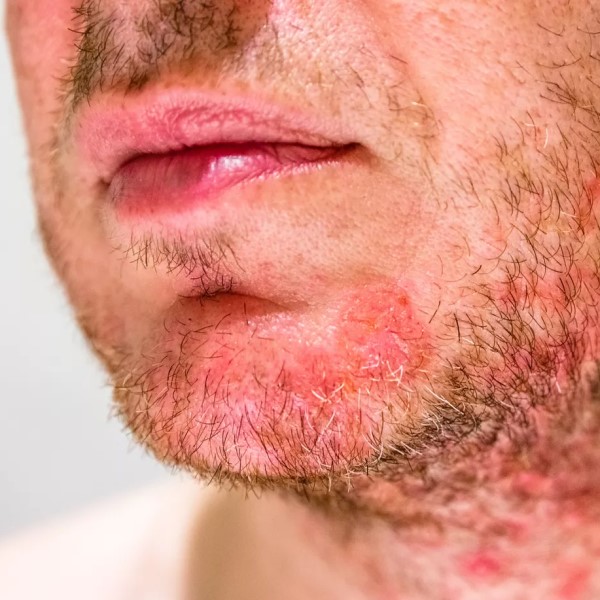 Dermatitis, Kozmetika s kanabinoidi, CBD, kanabinoidi, cannabinoids, Hempethica