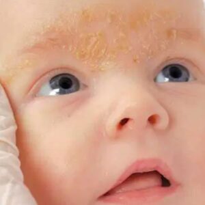 Atopijski dermatitis, Hempethica, Kanabinoidi, CBD
