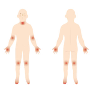 Hempethica Atopic Dermatitis CBD