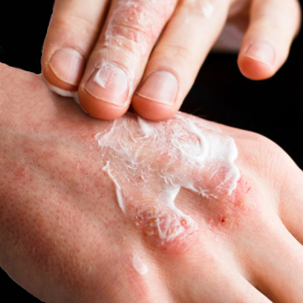 Dermatitis kozmetika s kanabinoidi CBD