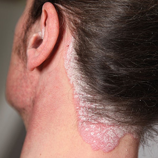 Luskavica, Psoriasis, Eczema, CBD, Kanabinoidi, Hempethica
