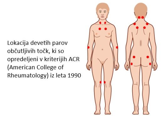 Fibromialgija, CBD, Kanabis, CBD Kapljice, Hempethica, Fibromyalgia, CBD Drops, Cannabis